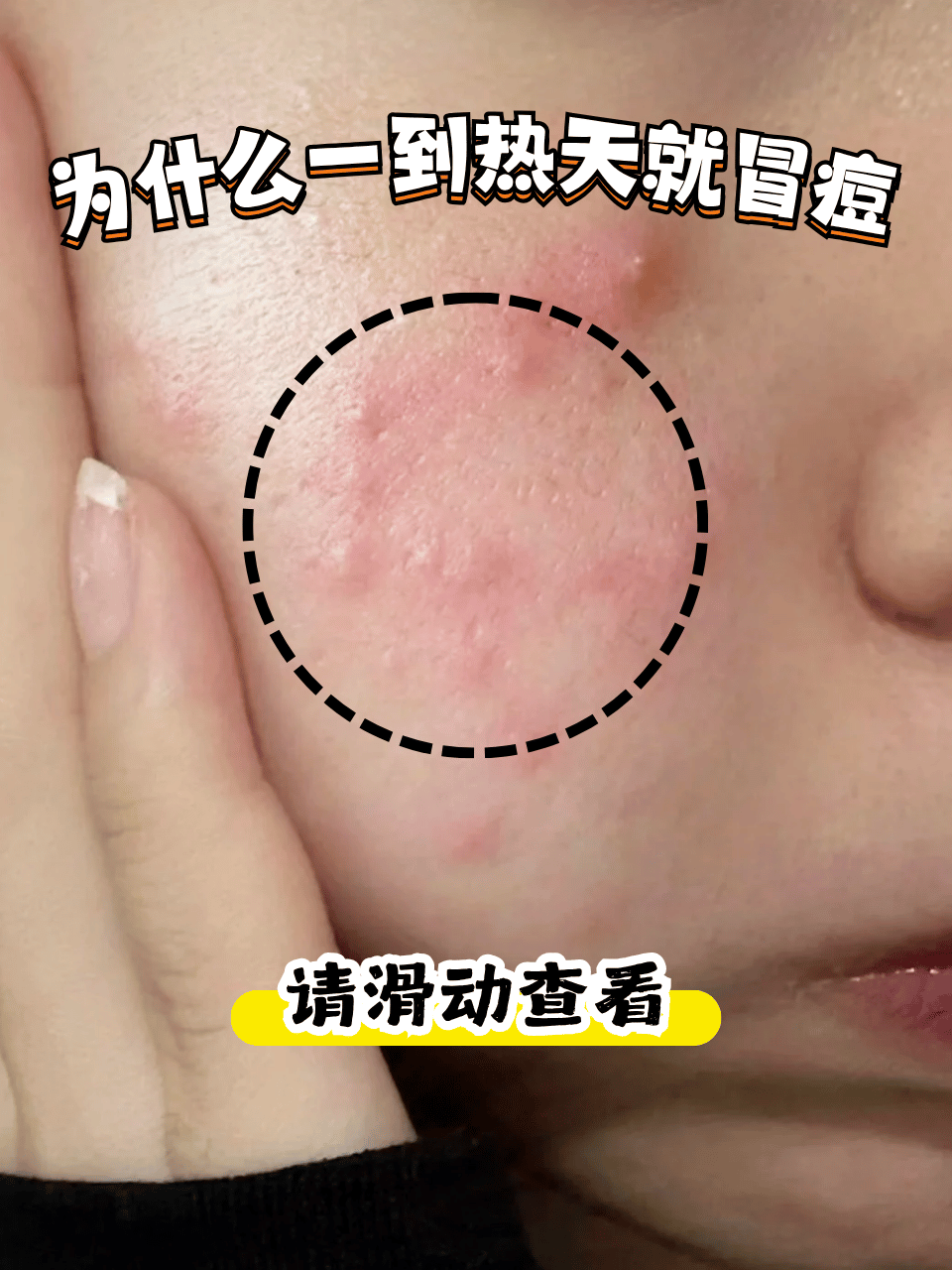 为什么爆痘了又痛又痒百科在线