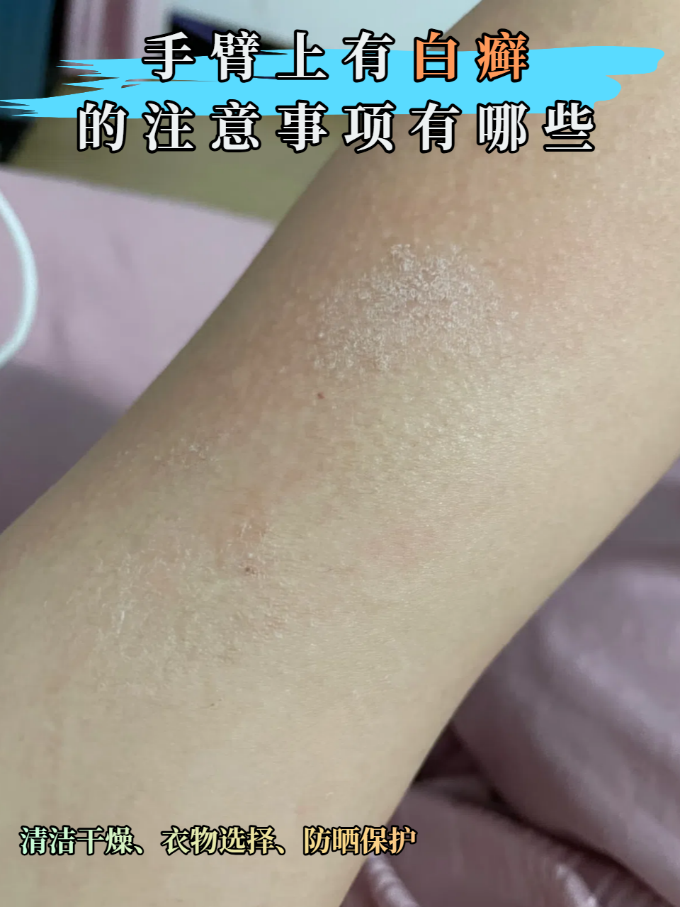 手臂上有白癣的注意事项有哪些