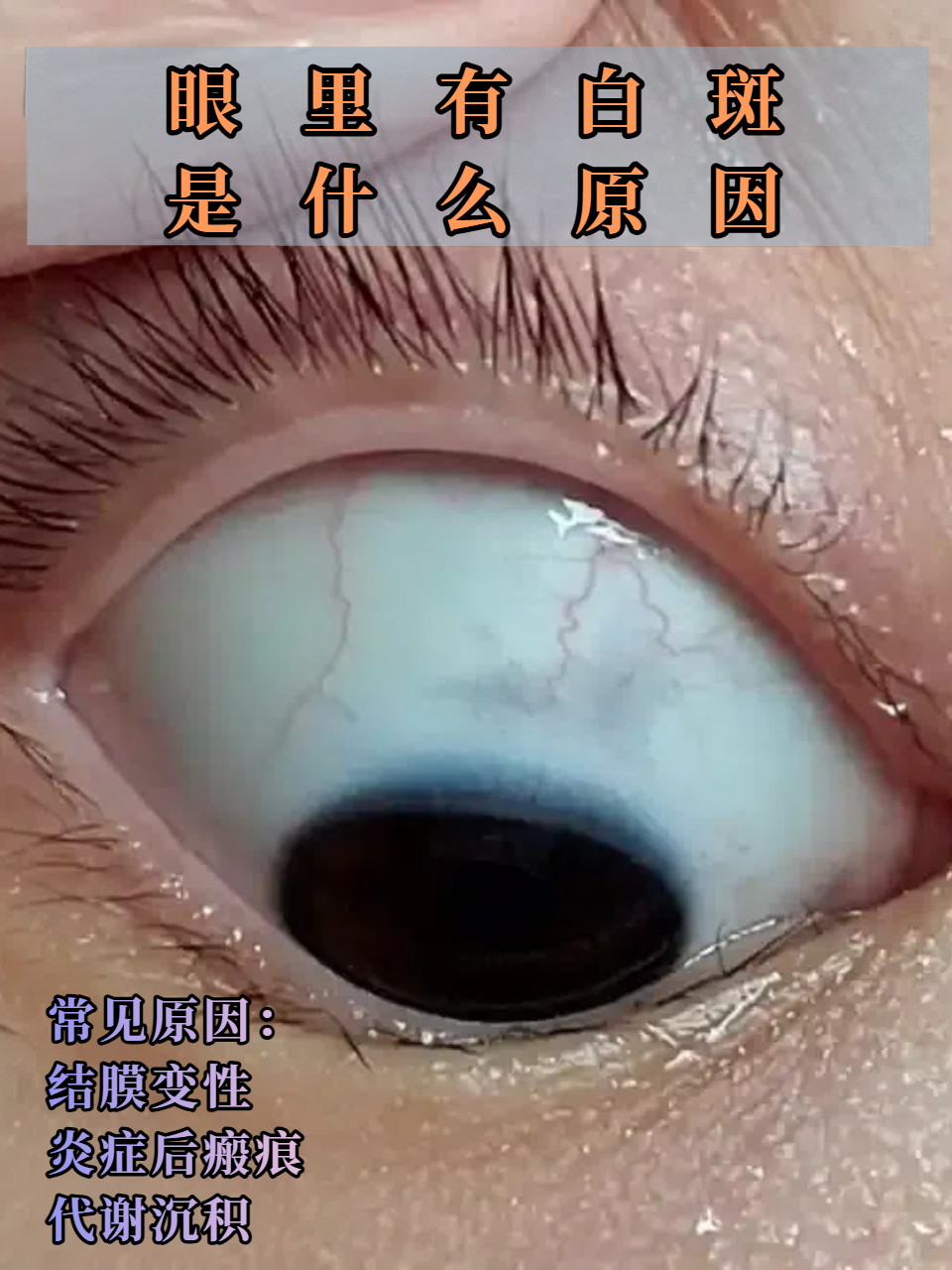 眼里有白斑是什么原因
