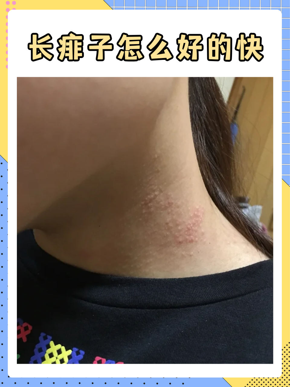 今天就来聊聊如何科学应对痱子困扰