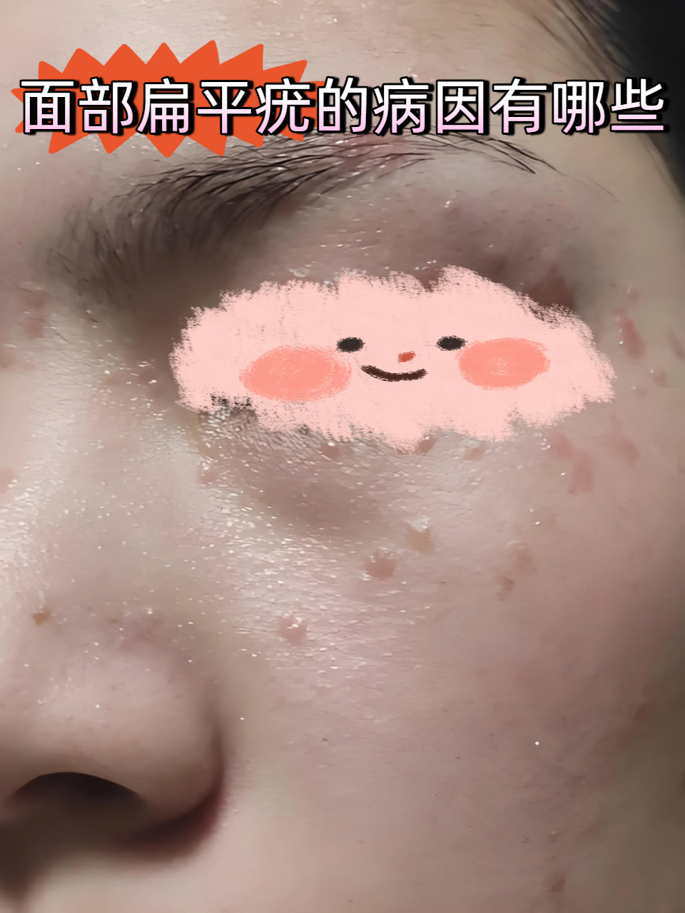 常见病因 病毒感染:hpv3型,10型等