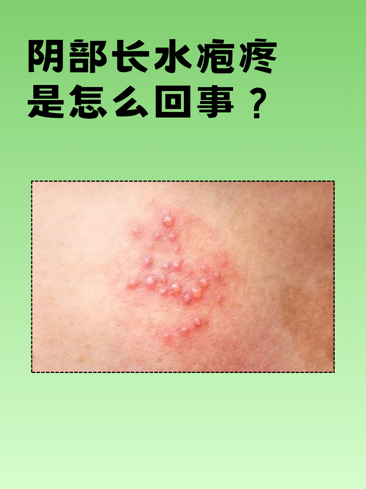 夏天私处突然出现水疱伴疼痛,可能是单纯疱疹病毒感染或带状疱疹等