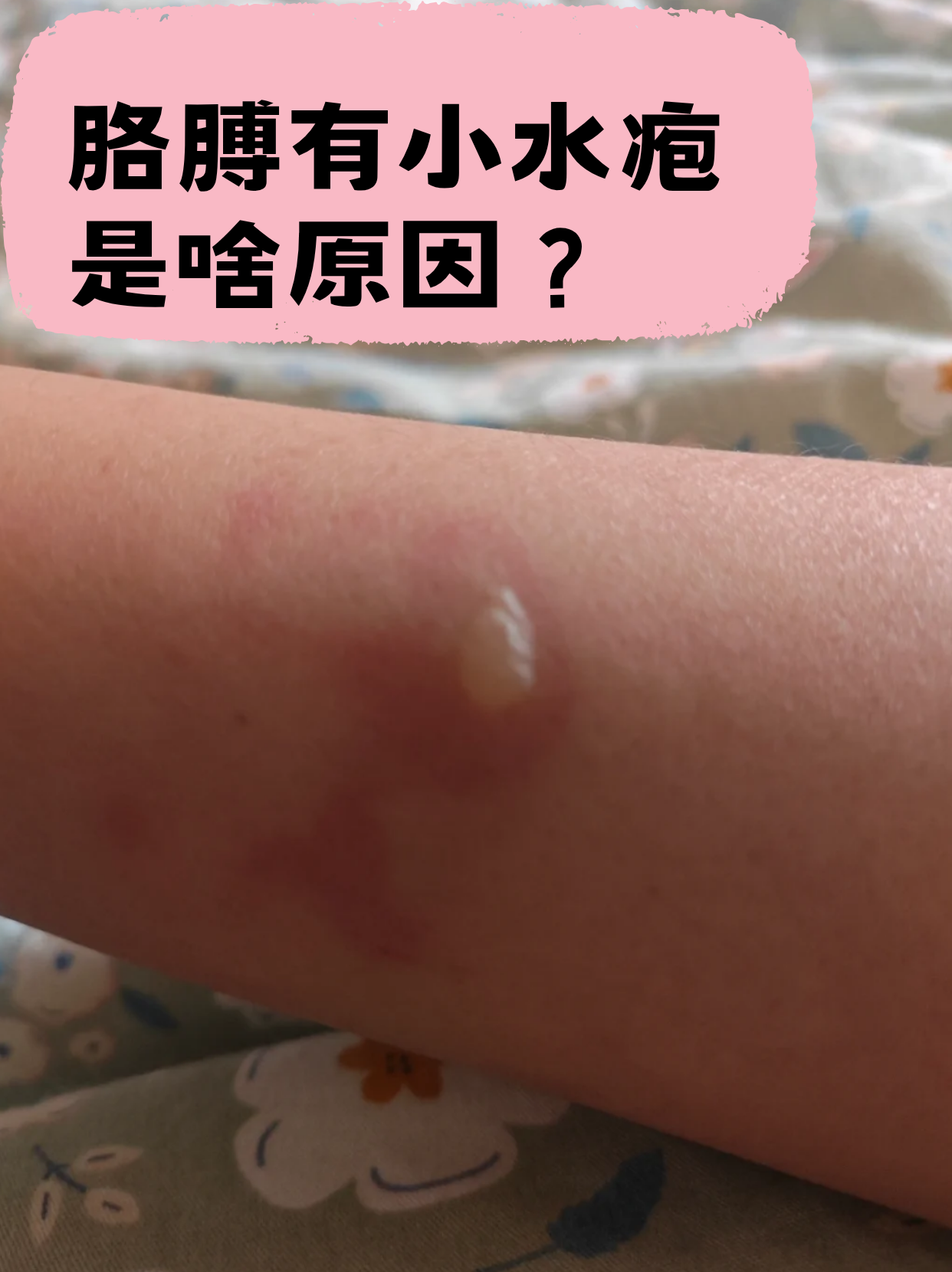 夏天气温升高,皮肤问题也悄悄冒头