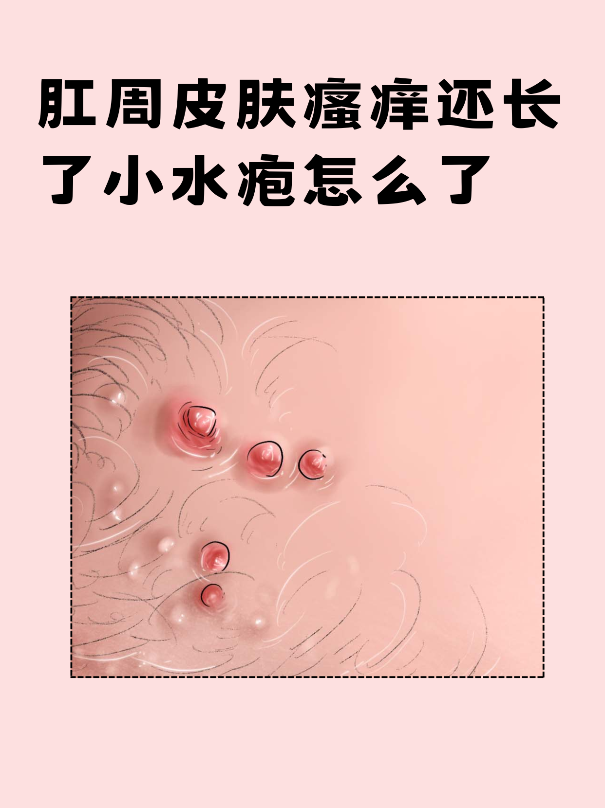 肛周皮肤瘙痒还长了小水疱怎么了