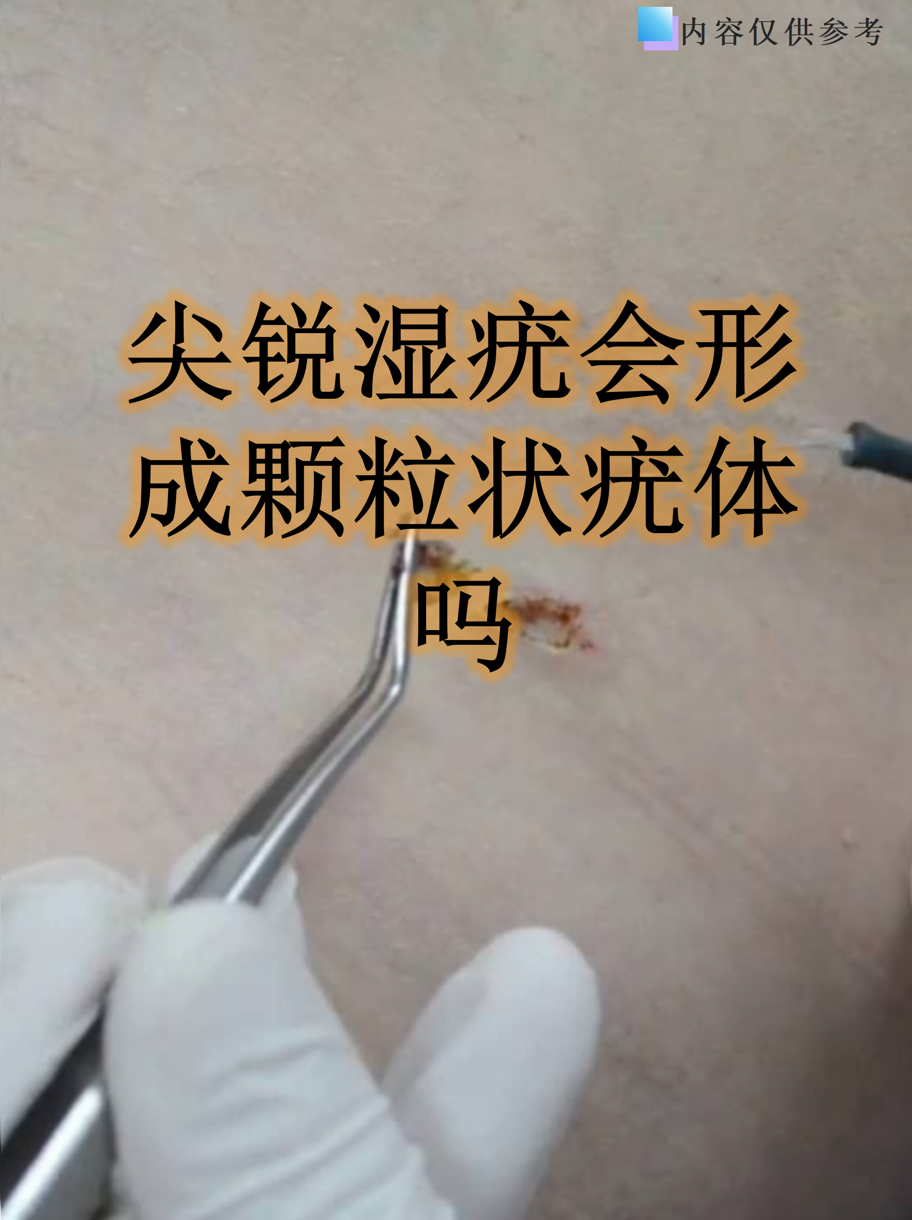 尖锐湿疣会形成颗粒状疣体吗