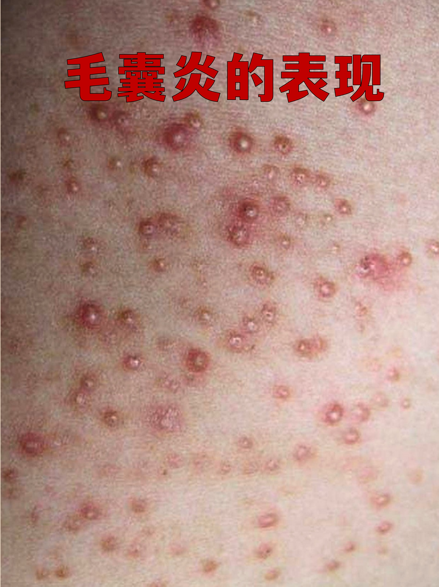皮肤上冒出红肿小疙瘩,可能是毛囊炎在作怪