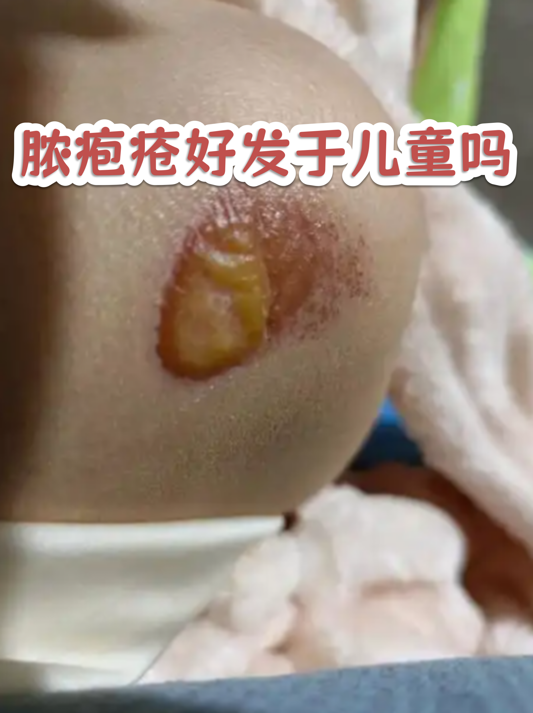 脓疱疮确实在儿童群体中更为常见,这与他们的皮肤屏障功能较弱,免疫
