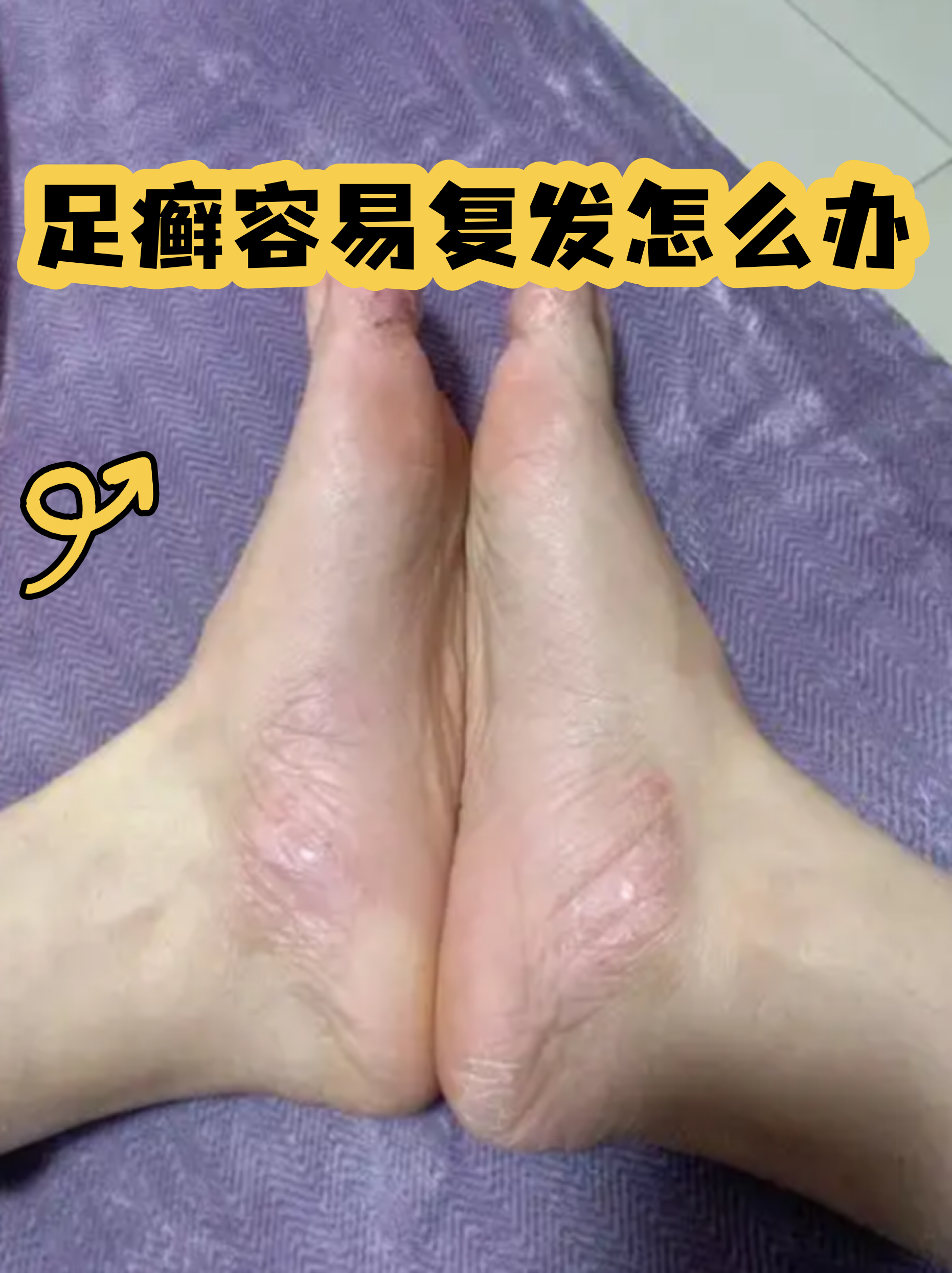 脚气反复发作让人头疼不已,这种真菌感染就像打