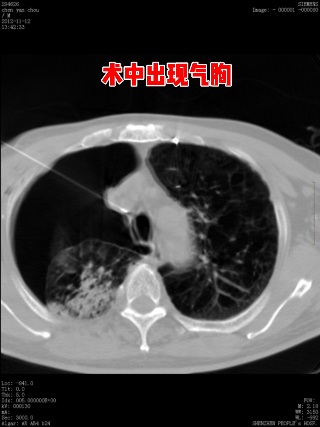 经mdt团队讨论,决定采用粒子植入治疗.