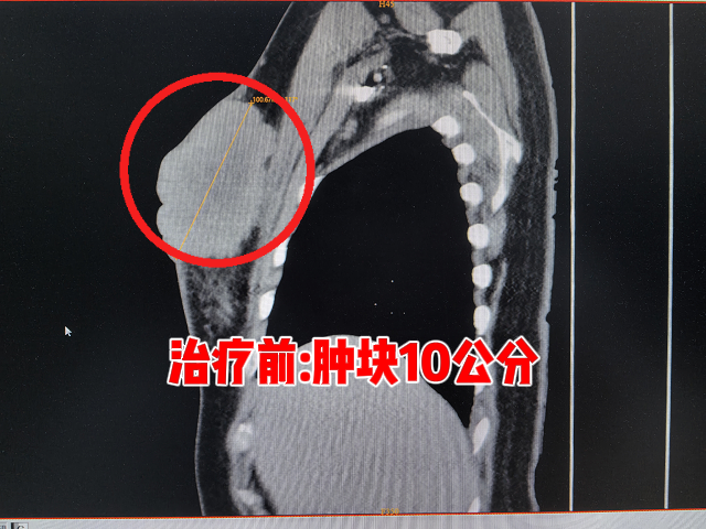 乳腺癌淋巴转移患者,肿瘤10公分,慕名找到我院,首次治疗肿块缩小30%