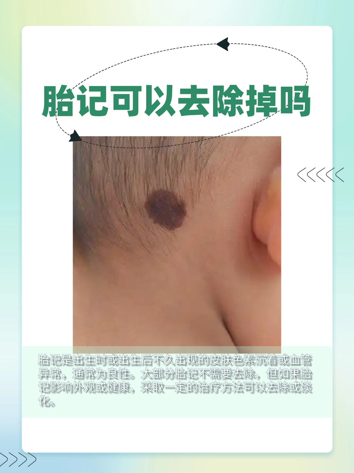 医生分享:胎记可以去除掉吗