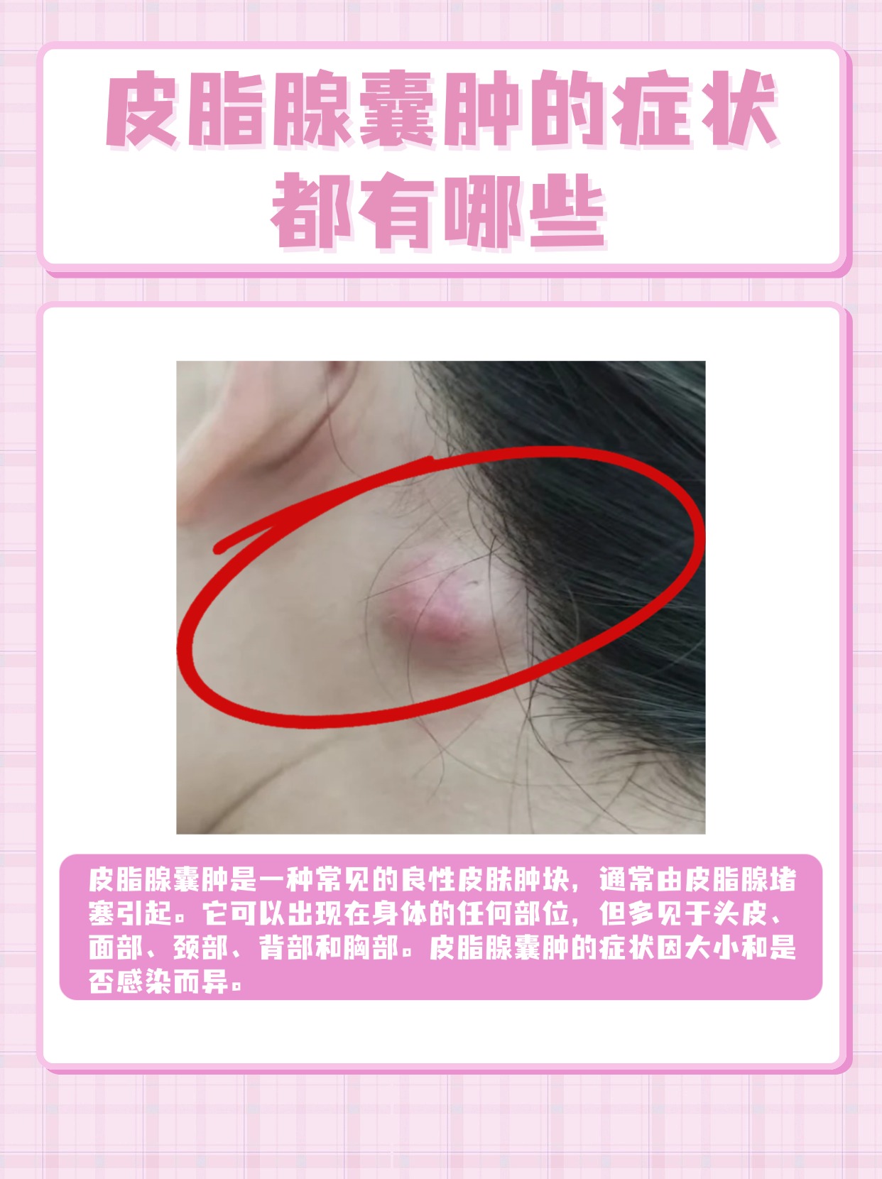 带你了解  皮脂腺囊肿是一种常见的良性皮肤肿块,通常由皮脂腺堵塞
