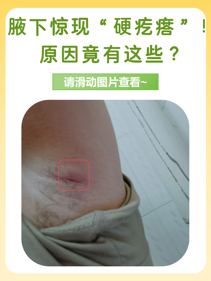 腋下惊现"硬疙瘩"!原因竟有这些?