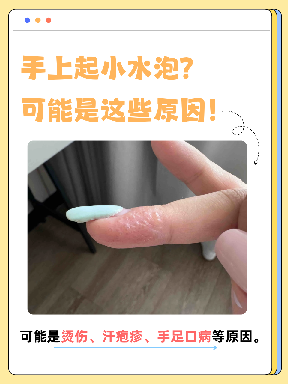 天气一热手上就起小水泡今日情况