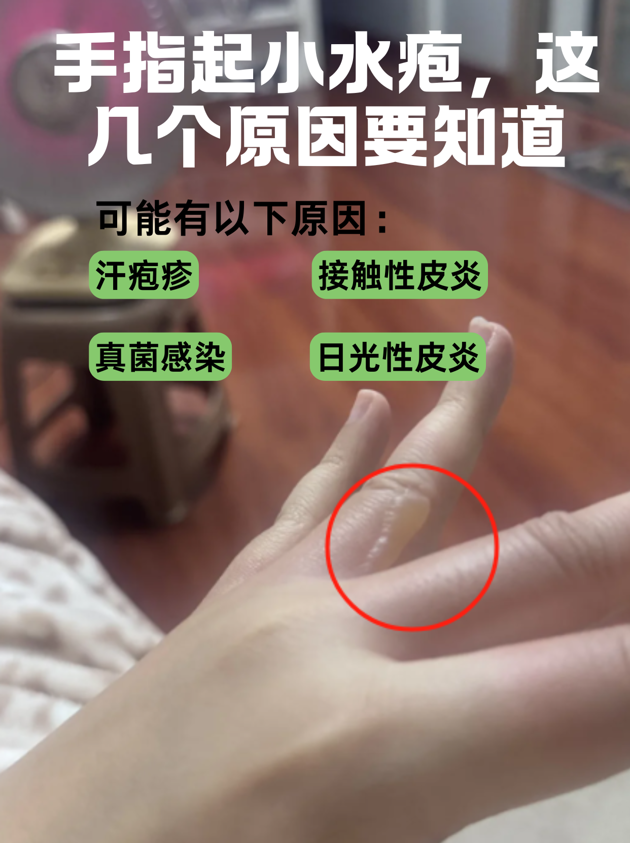 手上为什么会起小水泡