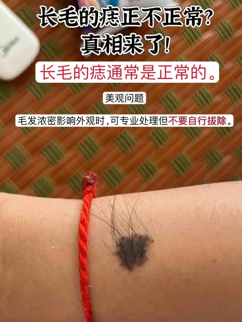 长毛的痣正不正常?真相来了!