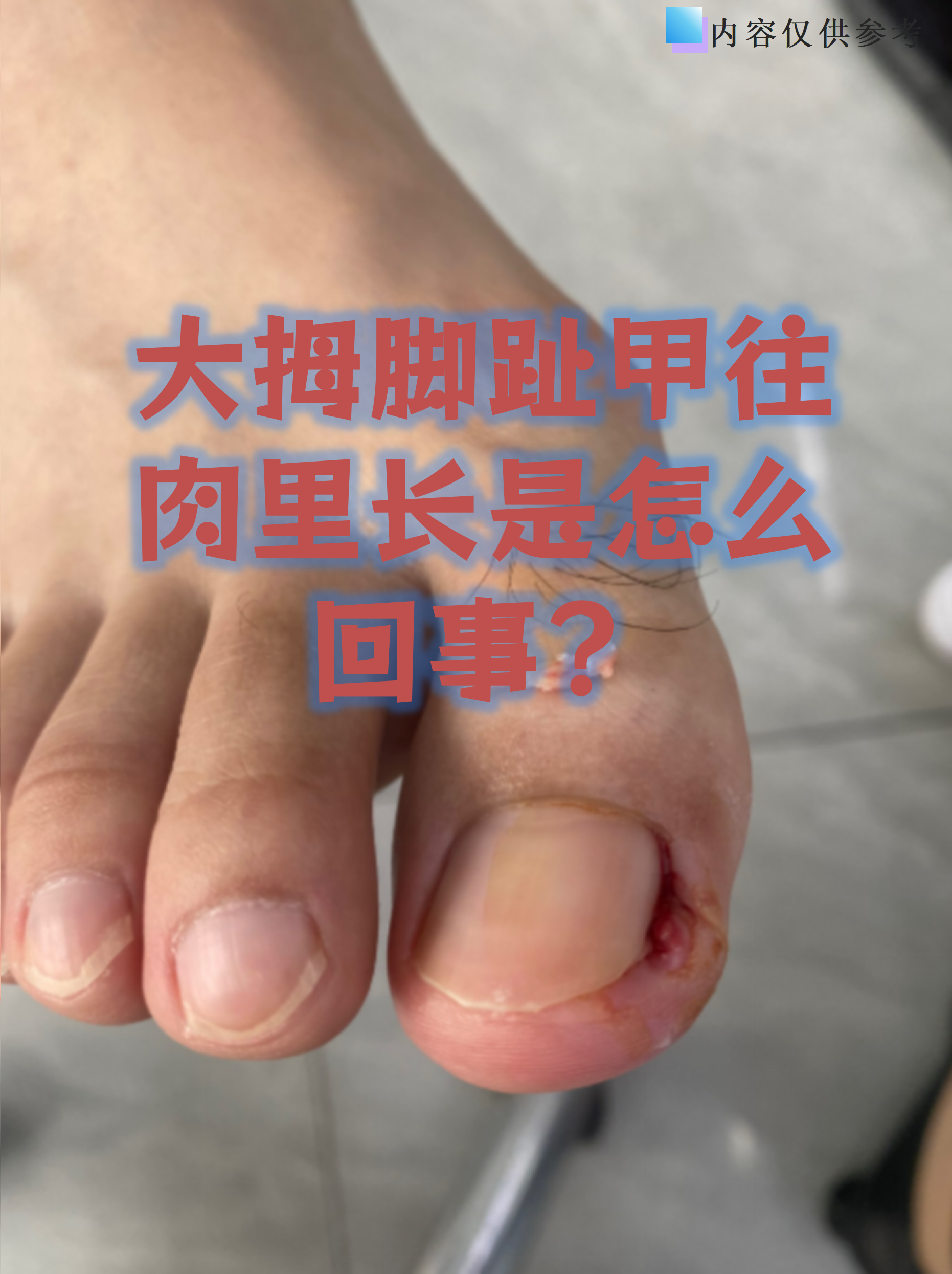 大拇脚趾甲往肉里长是怎么回事?
