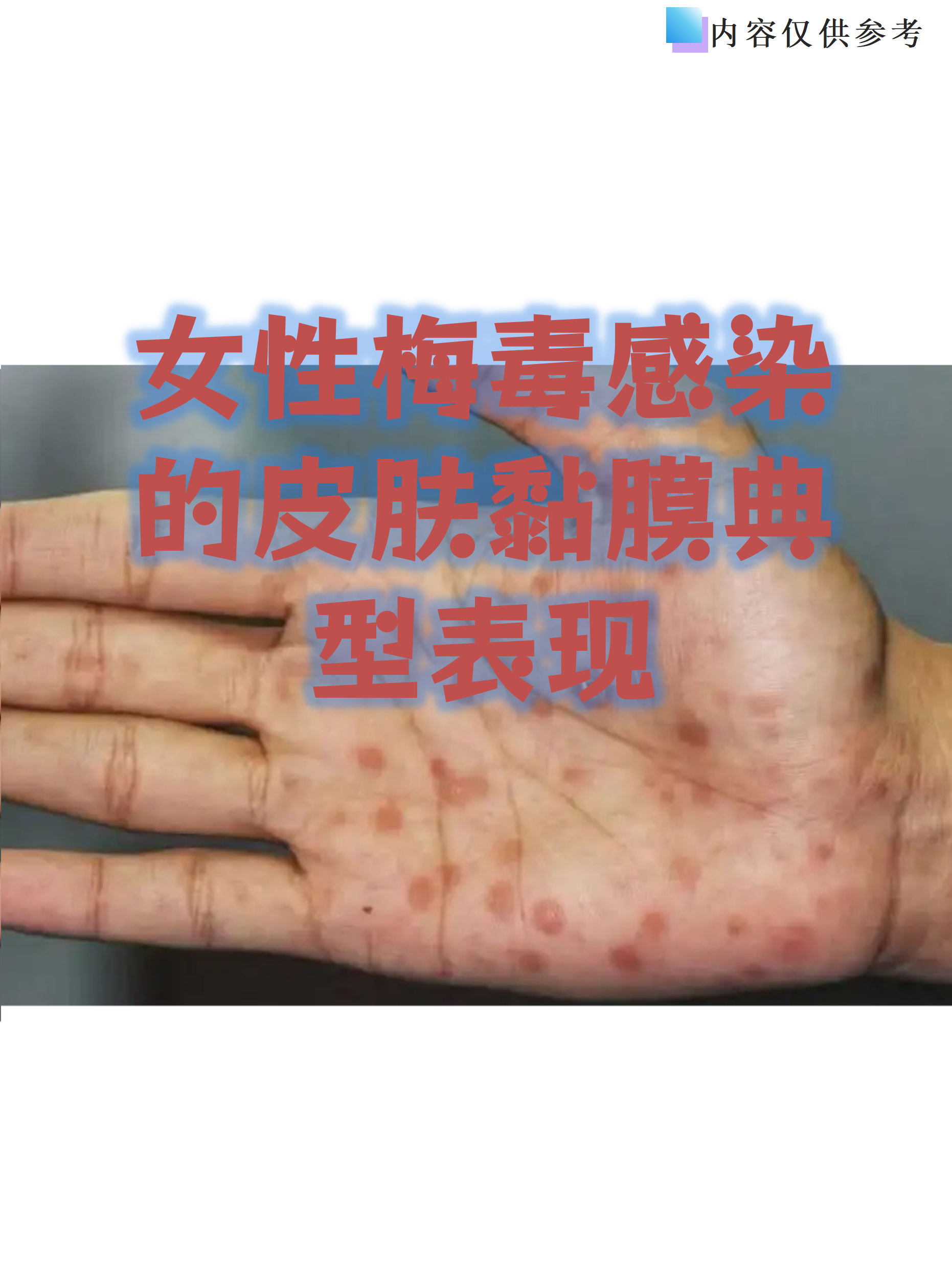 女性梅毒感染的皮肤黏膜典型表现