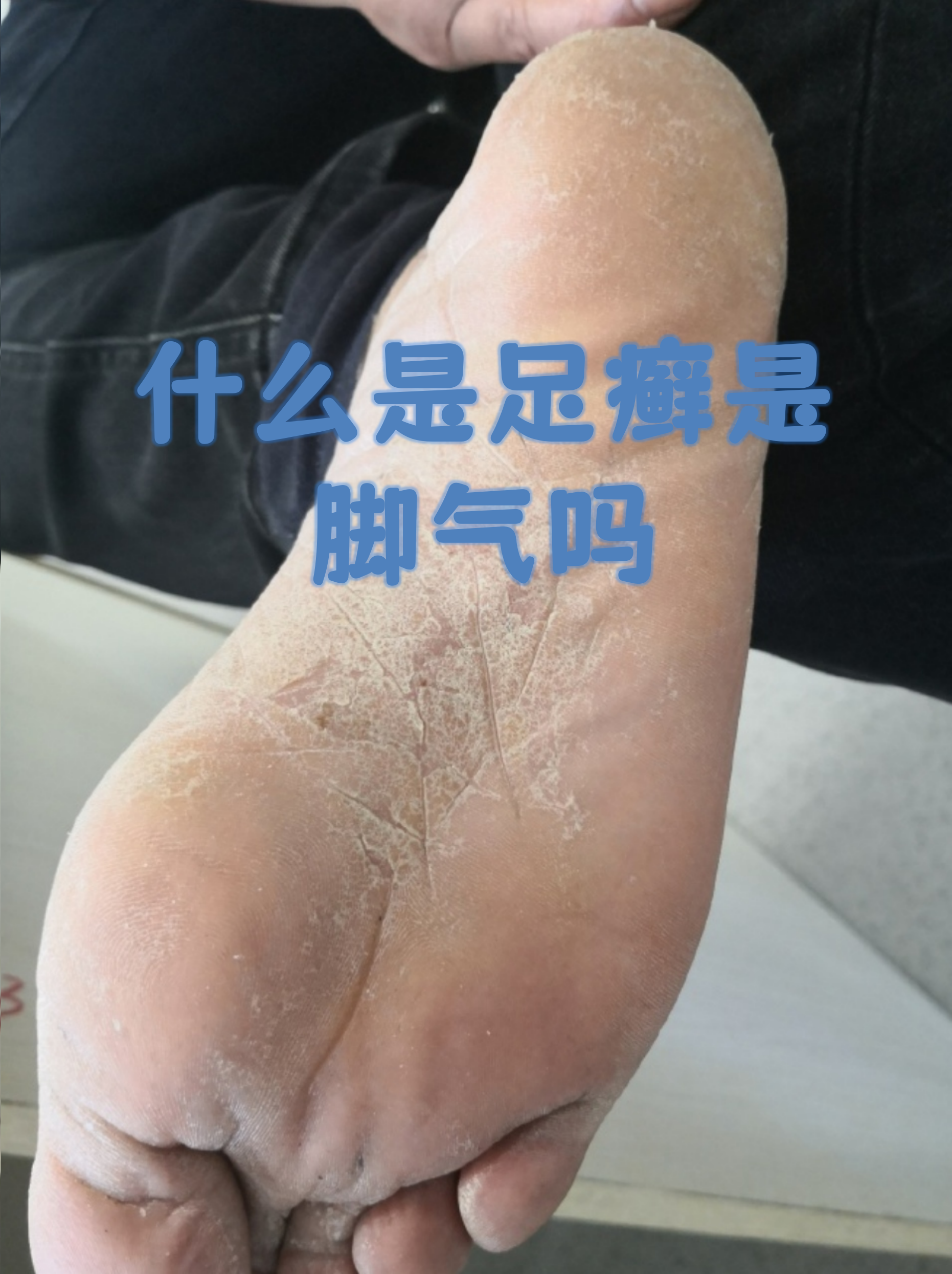 脚癣和脚气其实是同一种皮肤问题,都是指由真菌感染引起的足部皮肤 