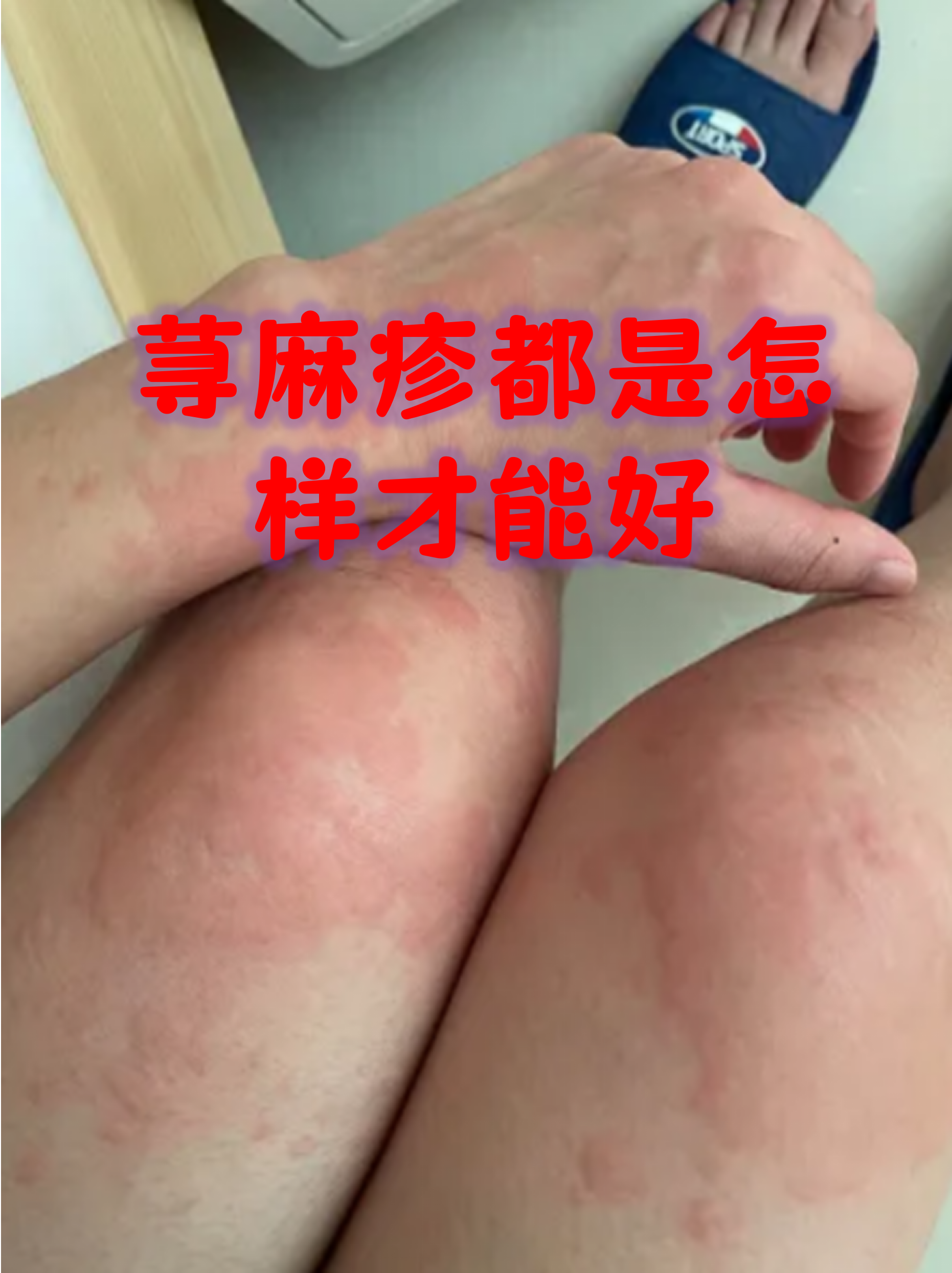 荨麻疹都是怎样才能好