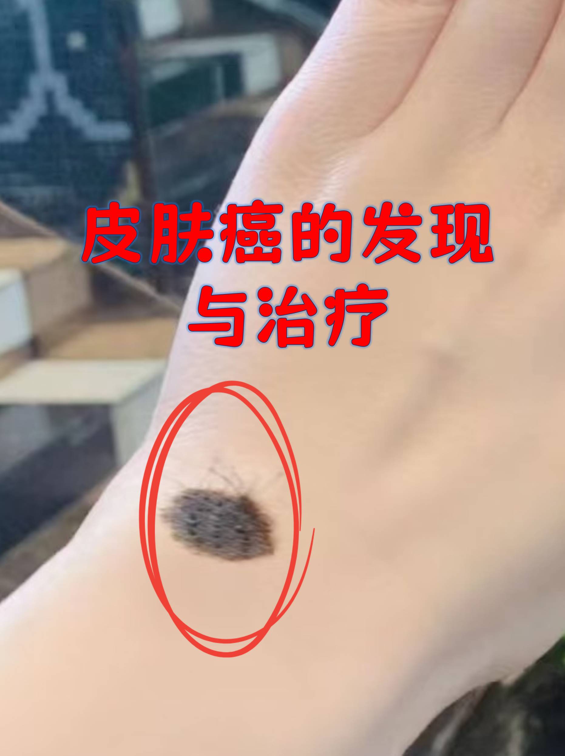 皮肤癌典型症状 不对称斑块痣或斑块形状