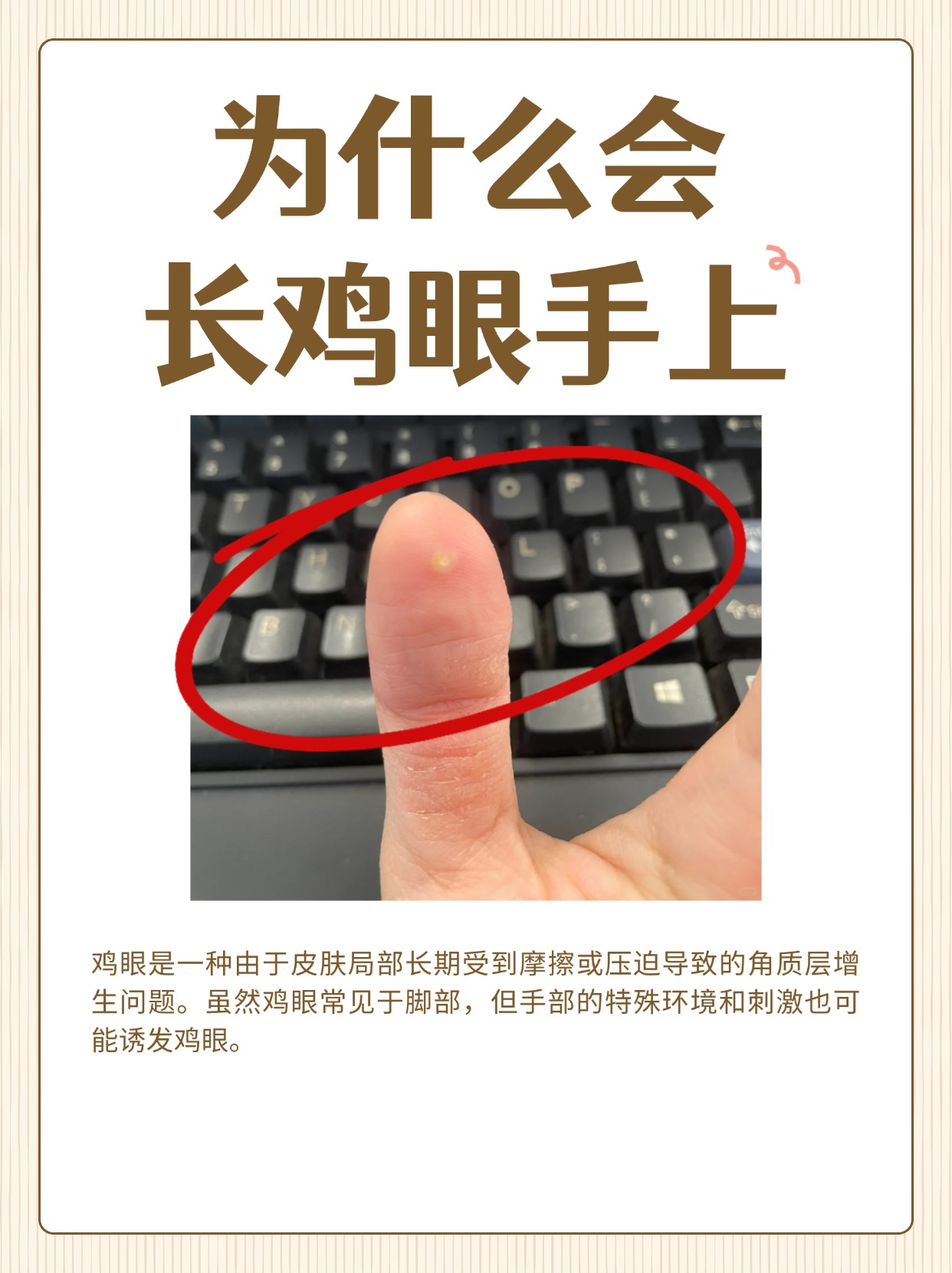 医生科普:为什么会长鸡眼手上