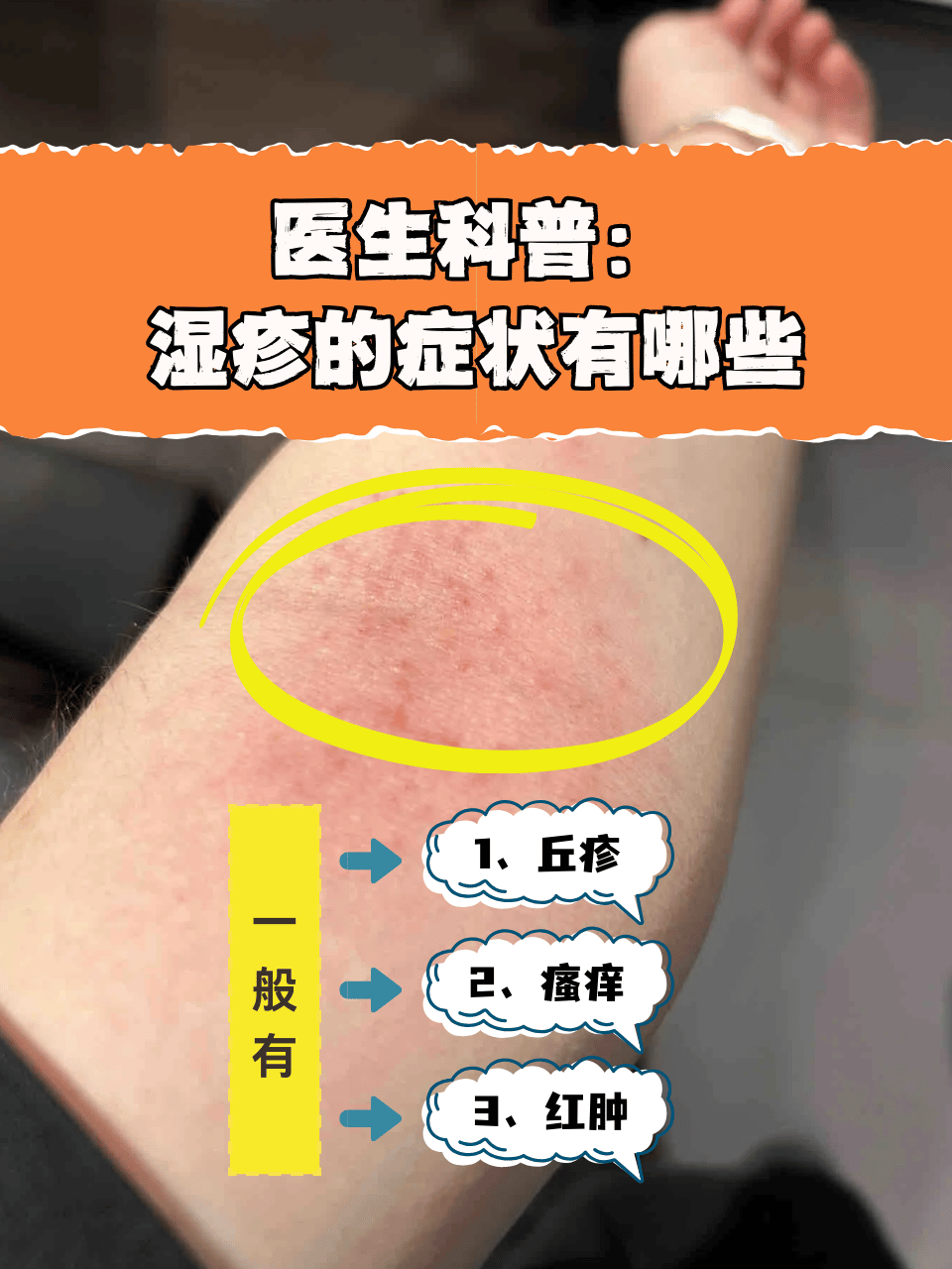 下面我们一起来了解一下,一般湿疹的症状有哪些吧!