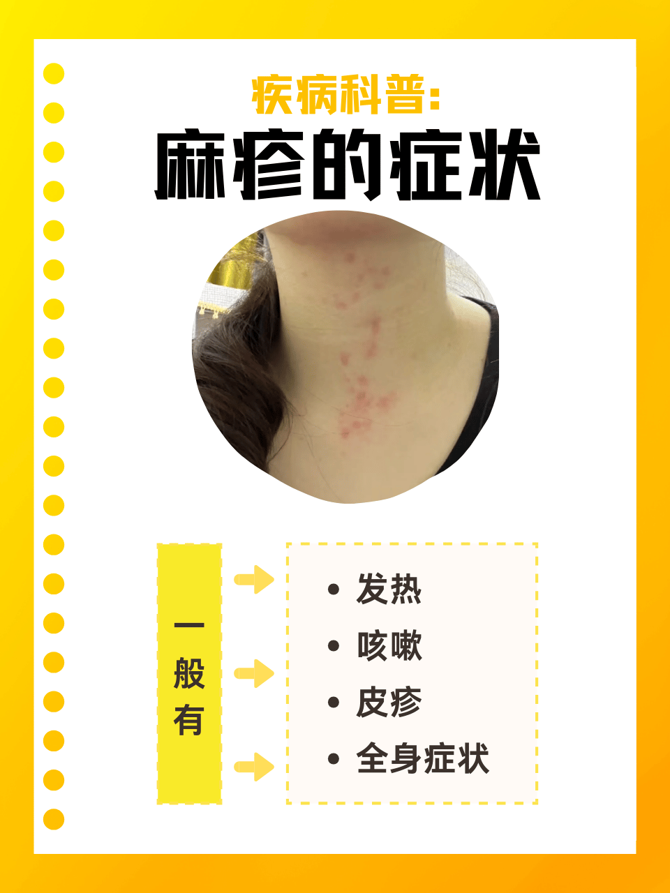是一种自限性疾病,具有高度传染性