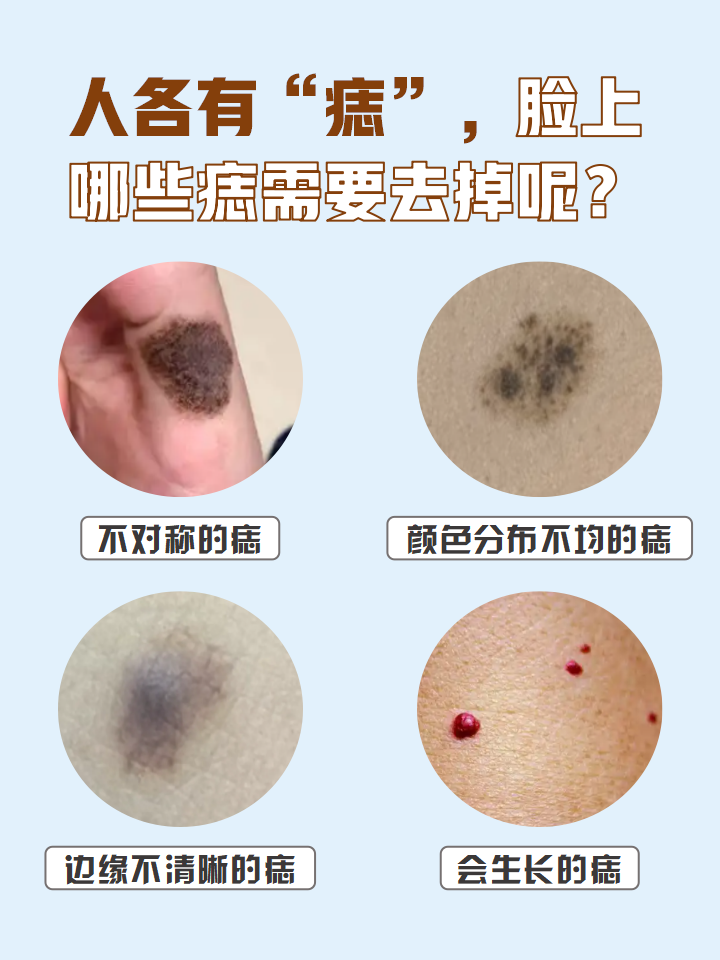 痣也叫做色素痣,可以分布在全身各处,包括脸部