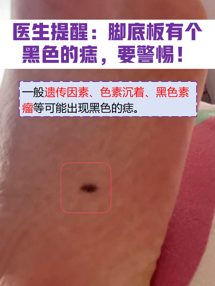女人最享福的8个痣为什么在线