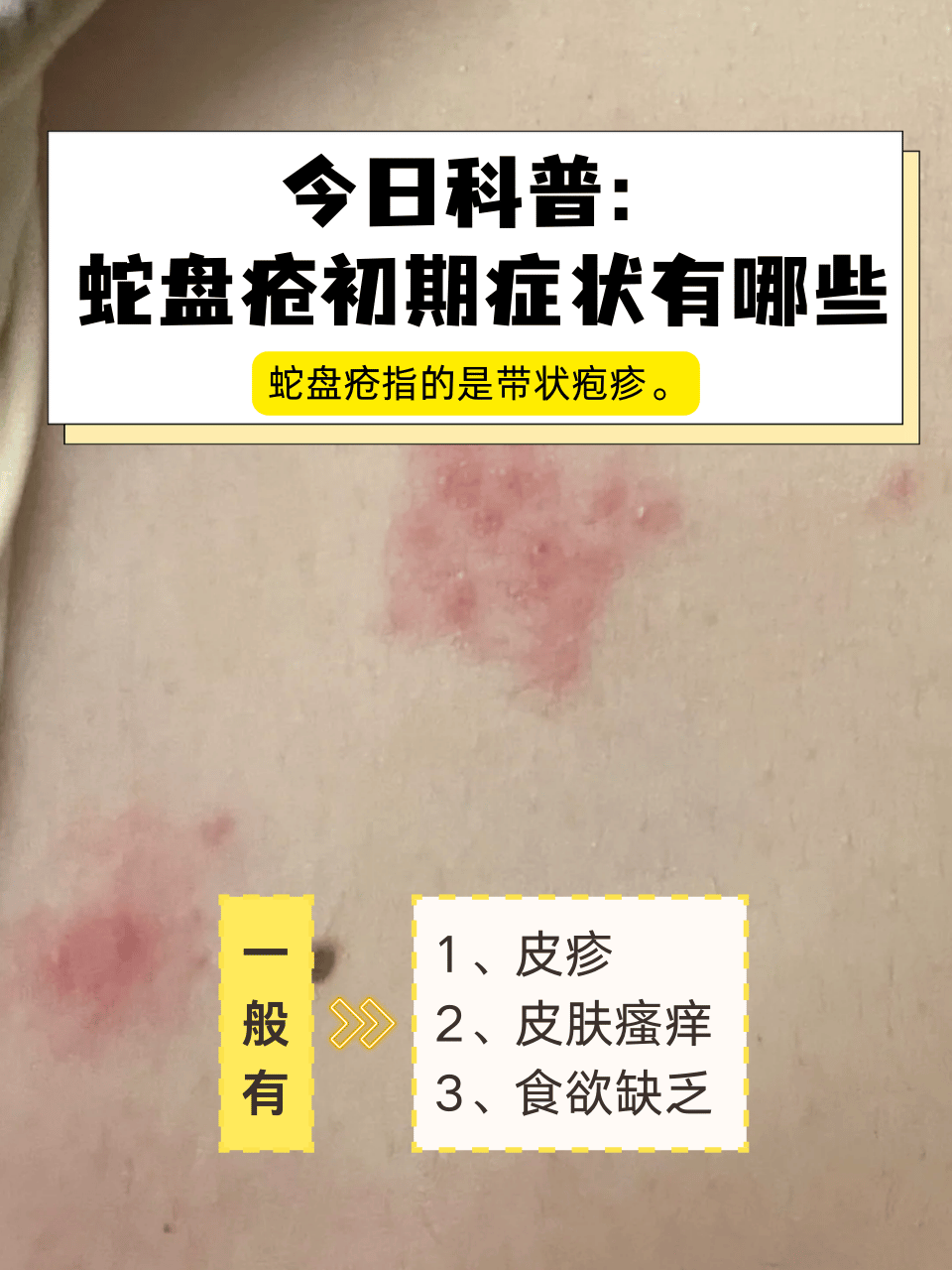 今日科普:蛇盘疮初期症状有哪些