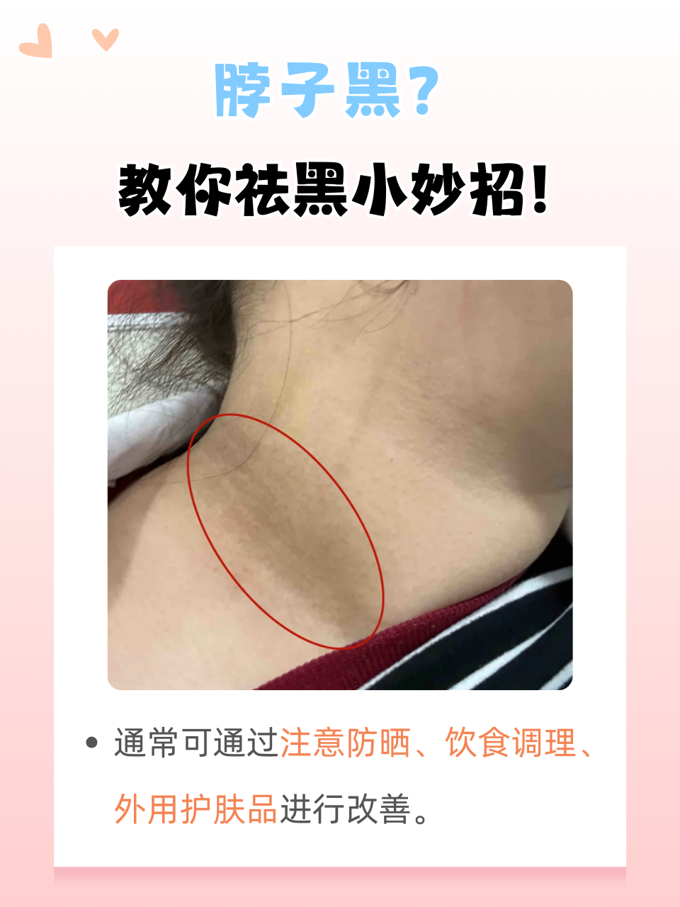 脖子黑?教你祛黑小妙招!