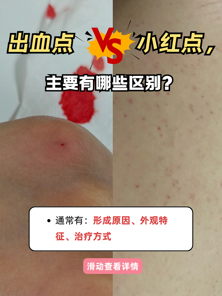 白血病红点辨别图片出血点和紫癜区别血液病早期皮肤图片白血病出血点