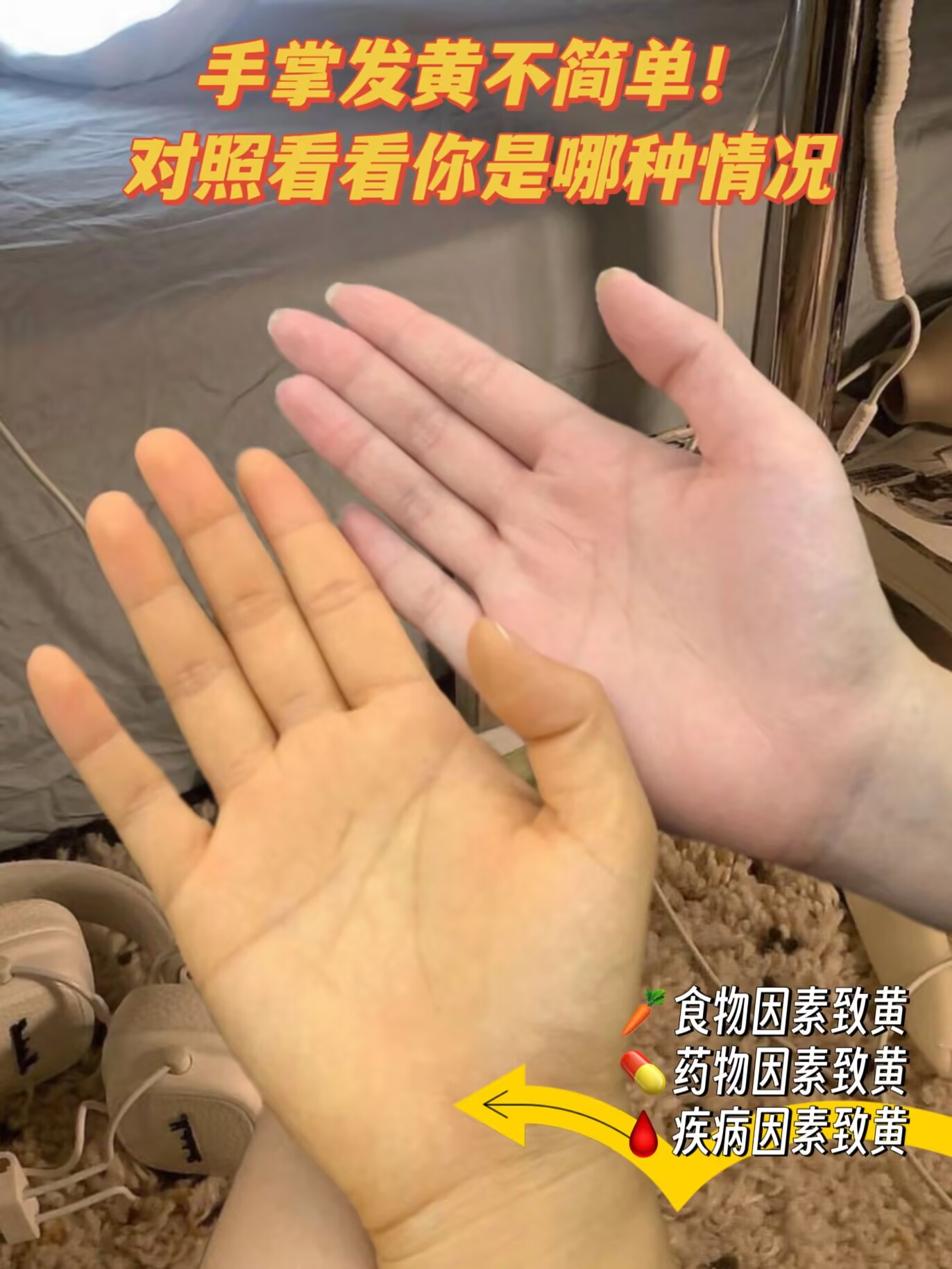手掌颜色在一定程度上能反映身体的健康状况
