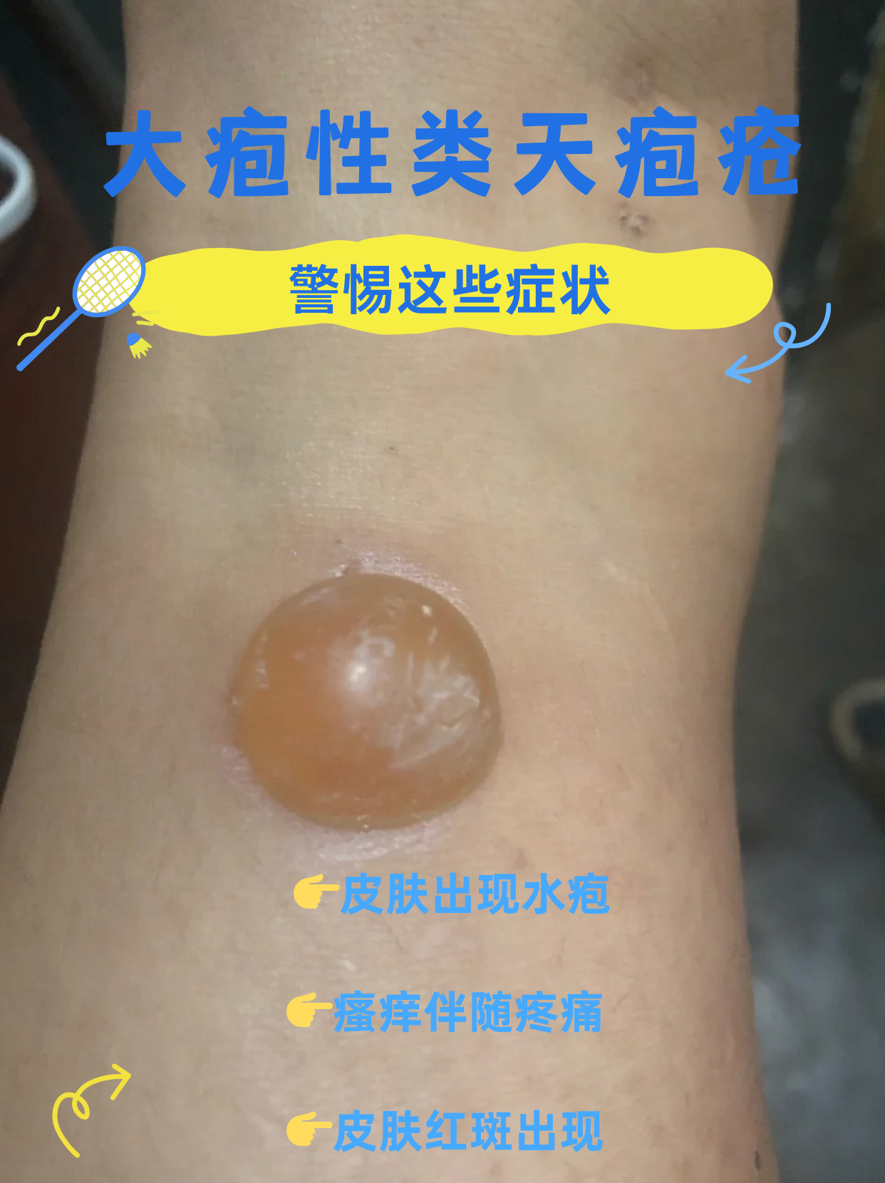 大疱性类天疱疮,警惕这些症状