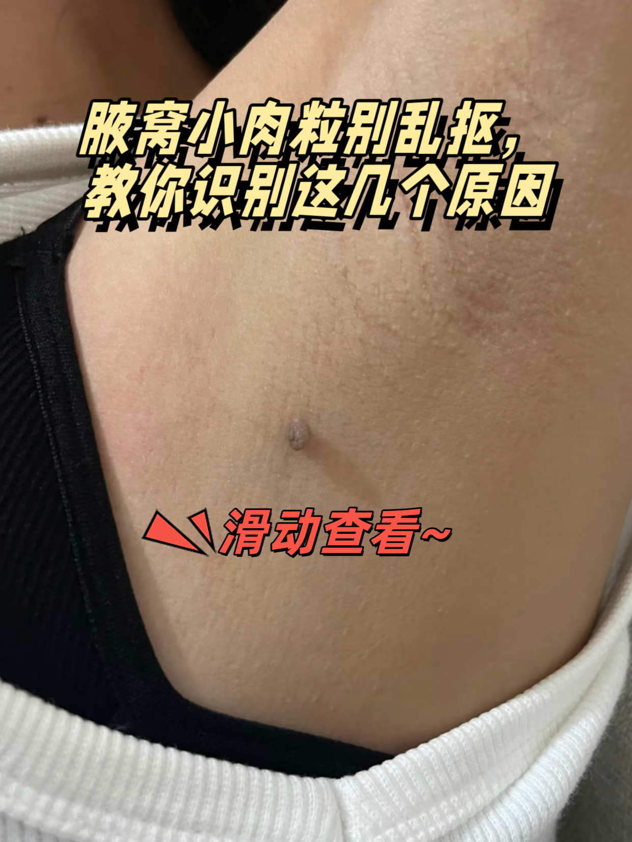 腋窝小肉粒别乱抠,教你识别这几个原因