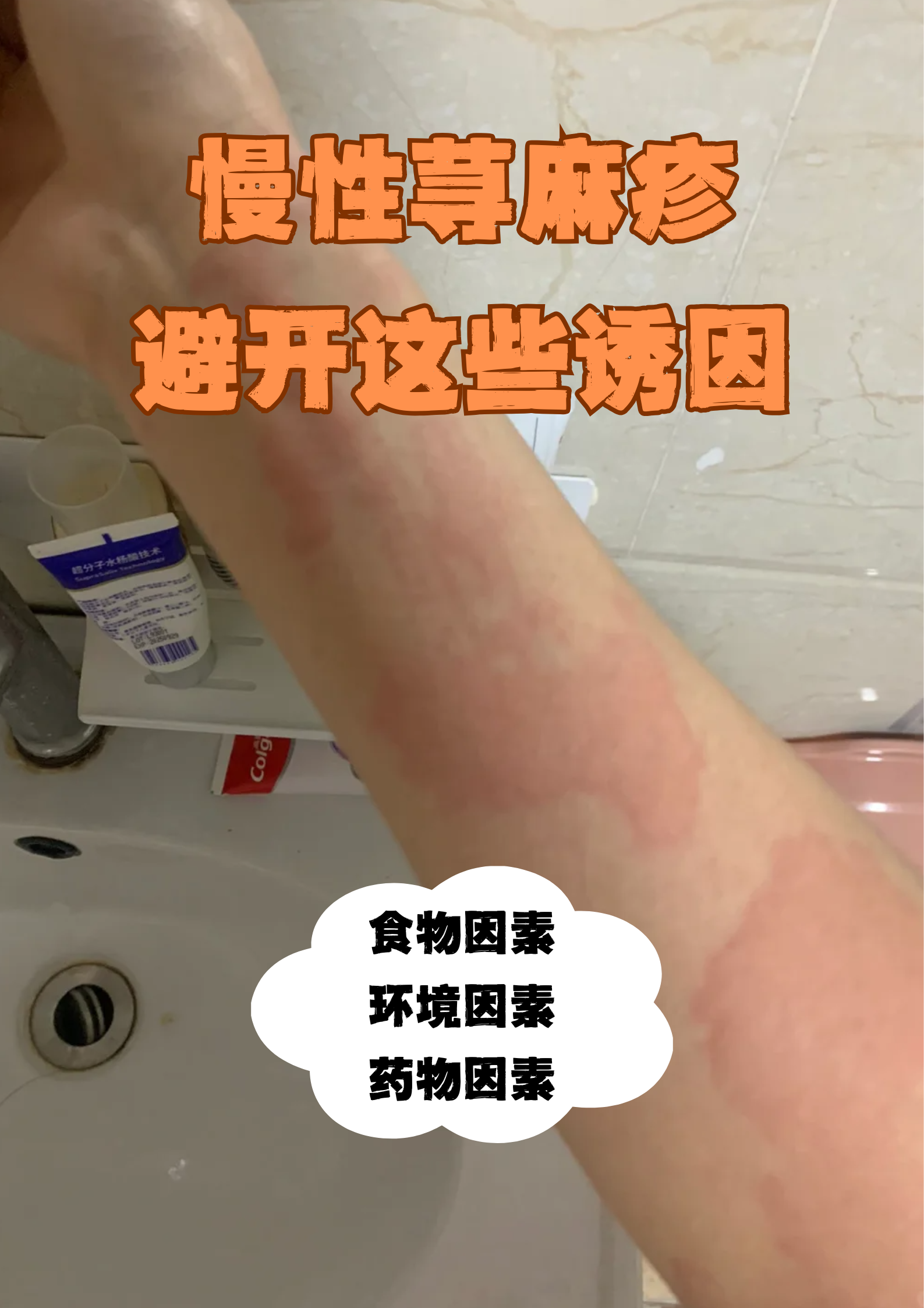 慢性荨麻疹,避开这些诱因