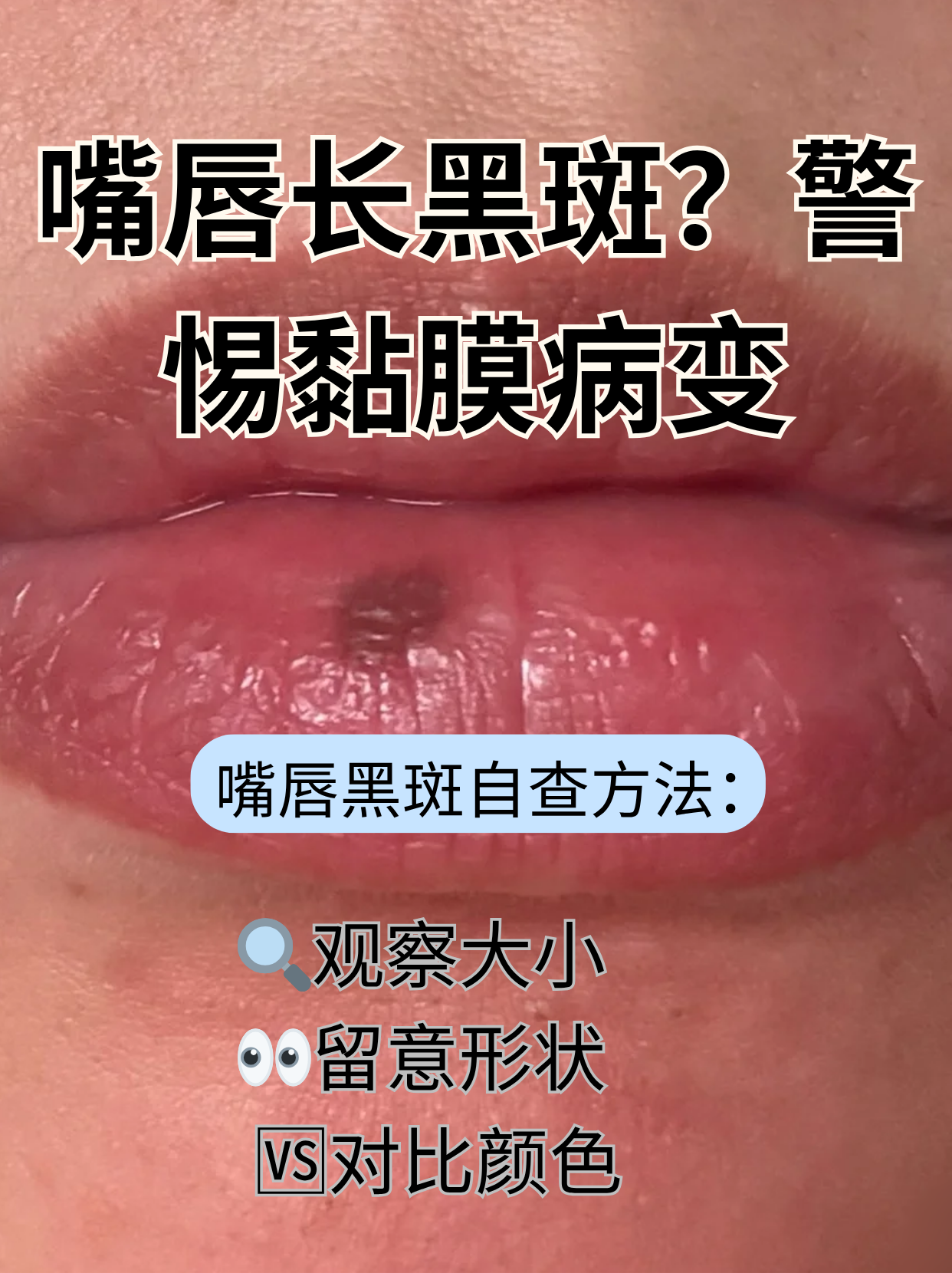 嘴唇突然长出黑斑,看似不起眼,实则可能是黏膜病变发出