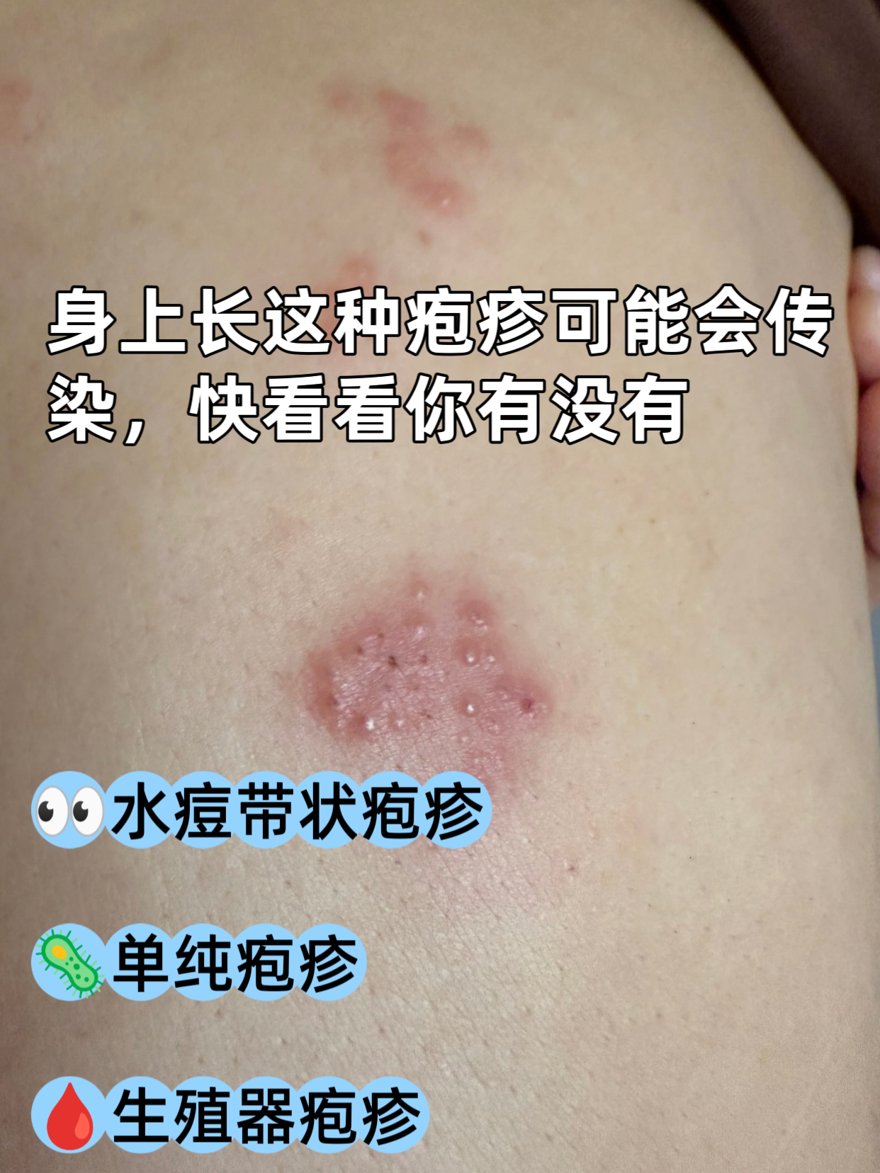 身上长这种疱疹可能会传染,快看看你有没有