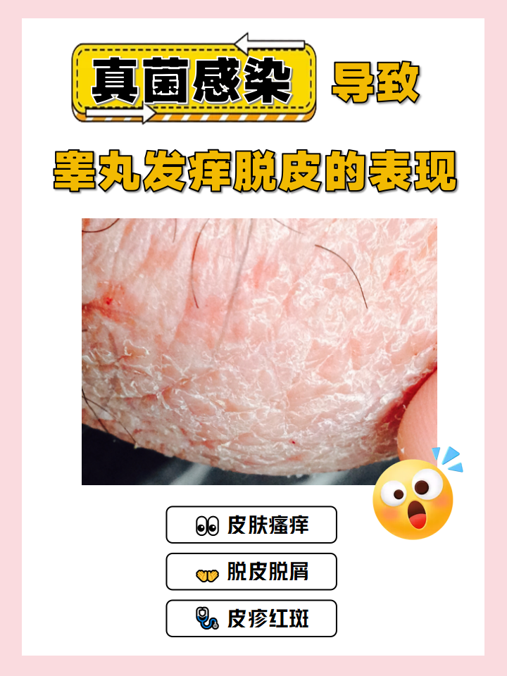 真菌感染导致睾丸发痒脱皮的表现