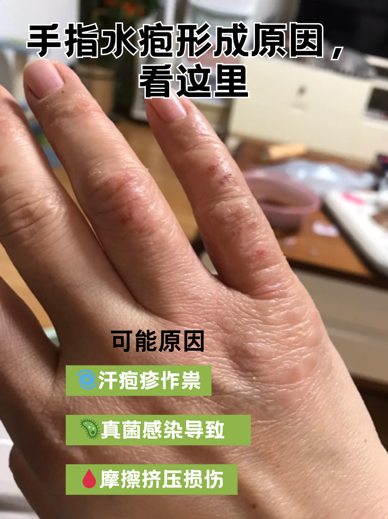 常表汗疱疹女性手上汗疱疹要警惕手指汗疱疹手指头真菌感染图片手指