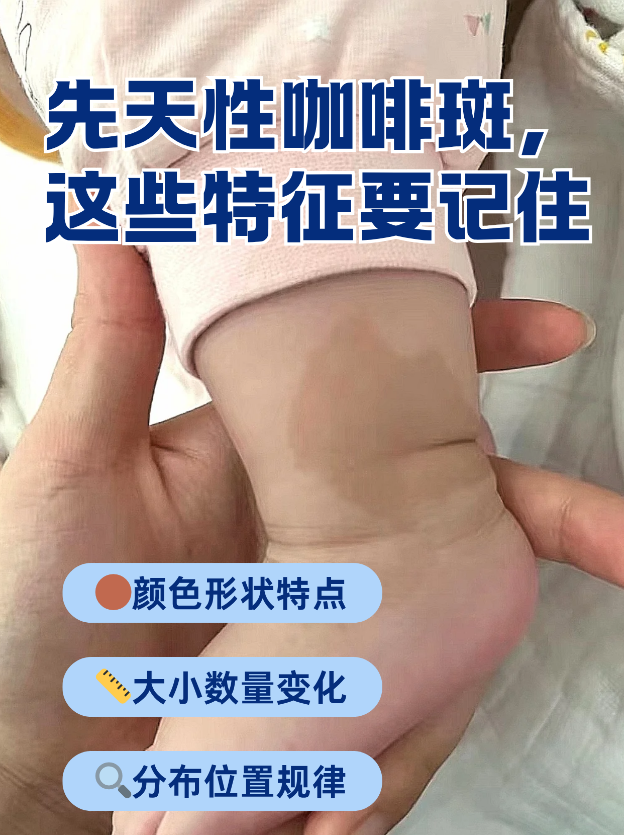 先天性咖啡斑,这些特征要记住