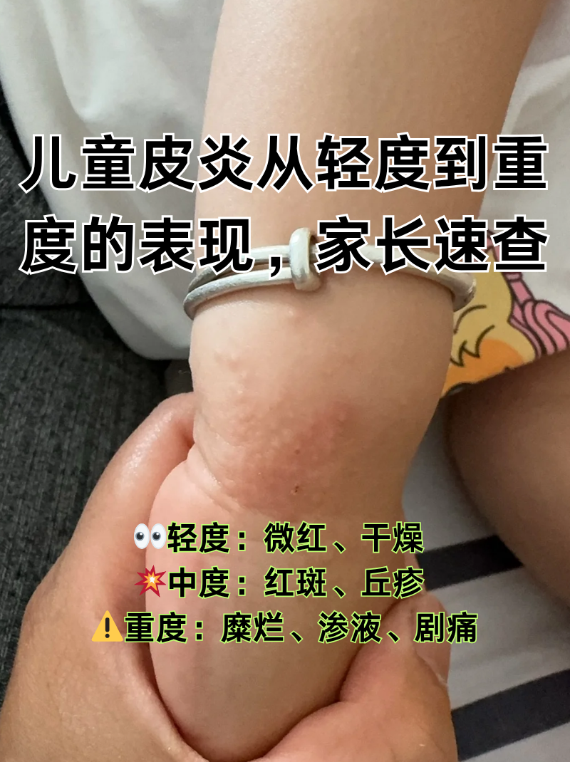 儿童皮炎从轻度到重度的表现,家长速查