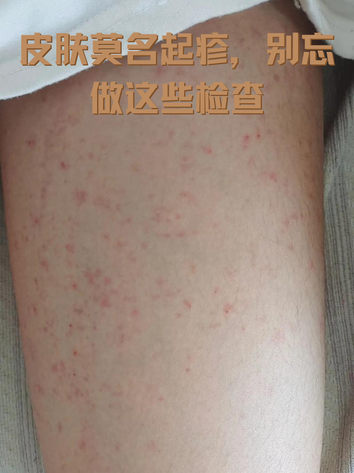 夏季高温潮湿,蚊虫,过敏原活跃,更需警惕皮肤异常变化