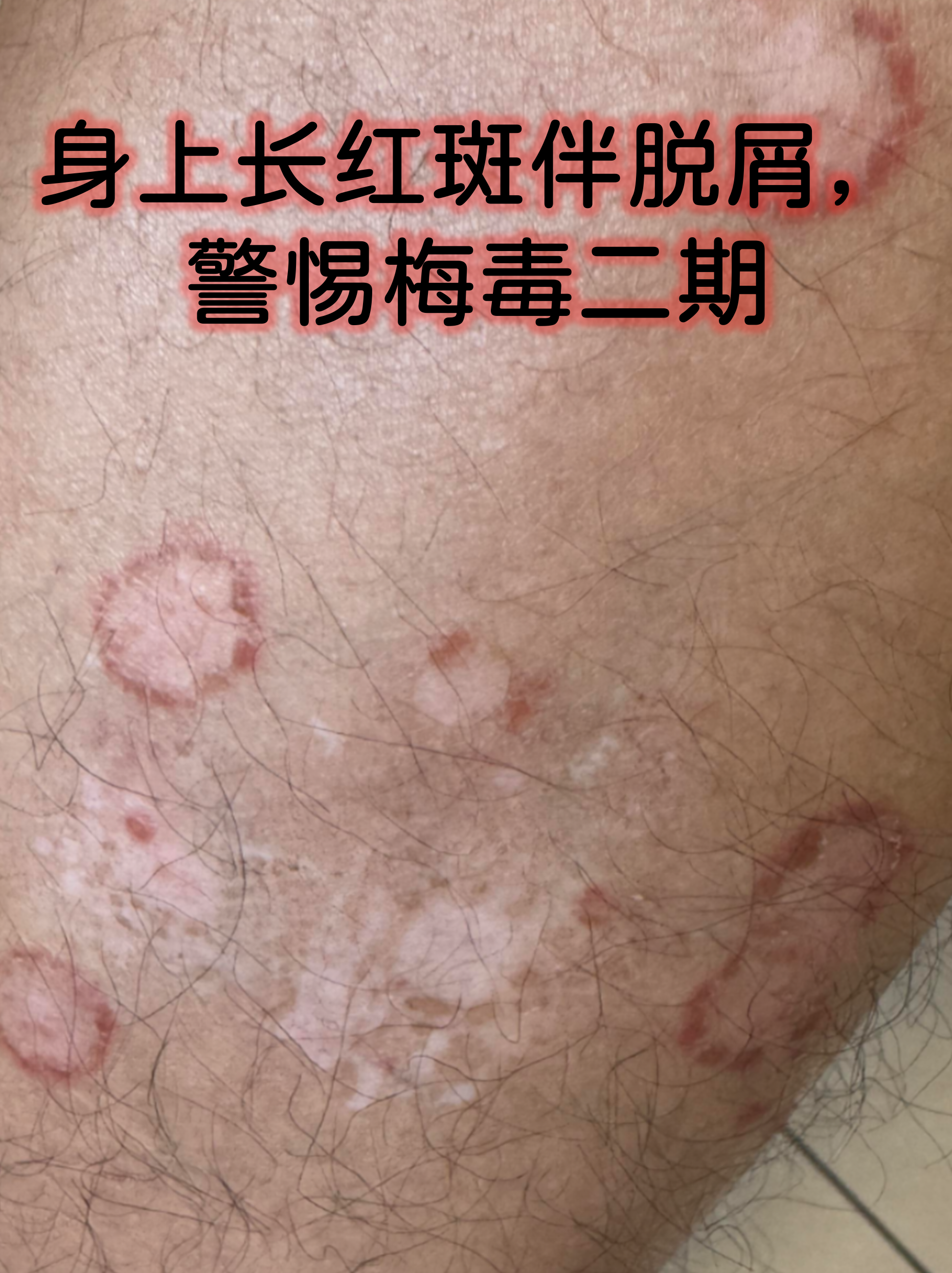 身上长红斑伴脱屑,警惕梅毒二期