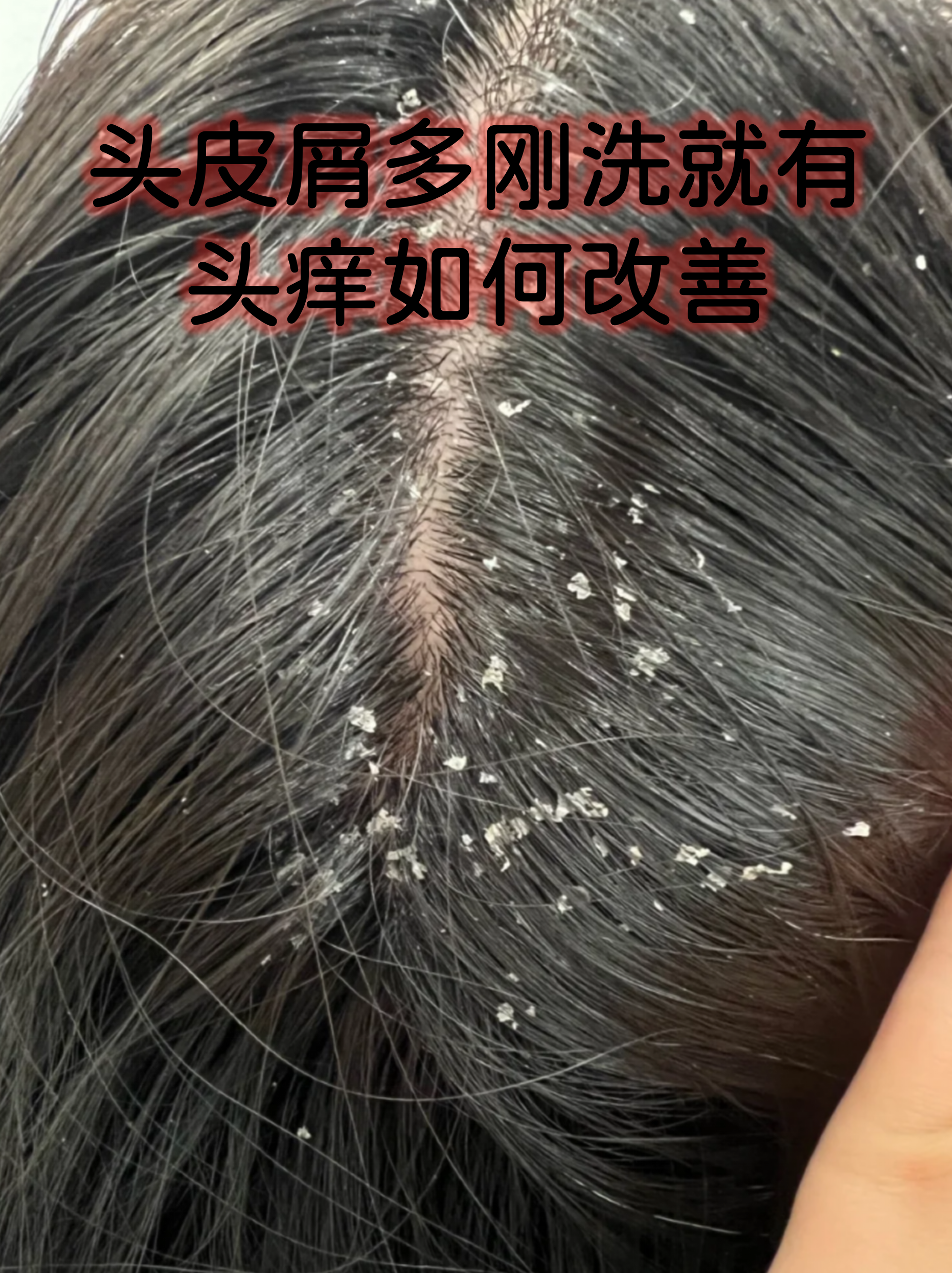 头皮屑多刚洗就有头痒如何改善
