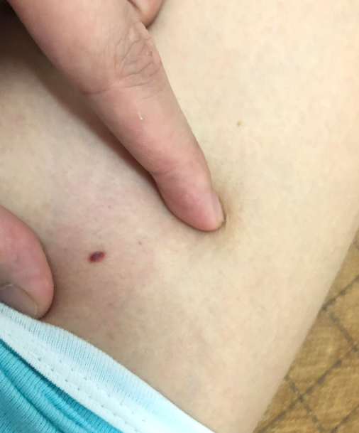 痣的本质是黑色素细胞聚集,多数是良性的,但特定情况下可能存在风险