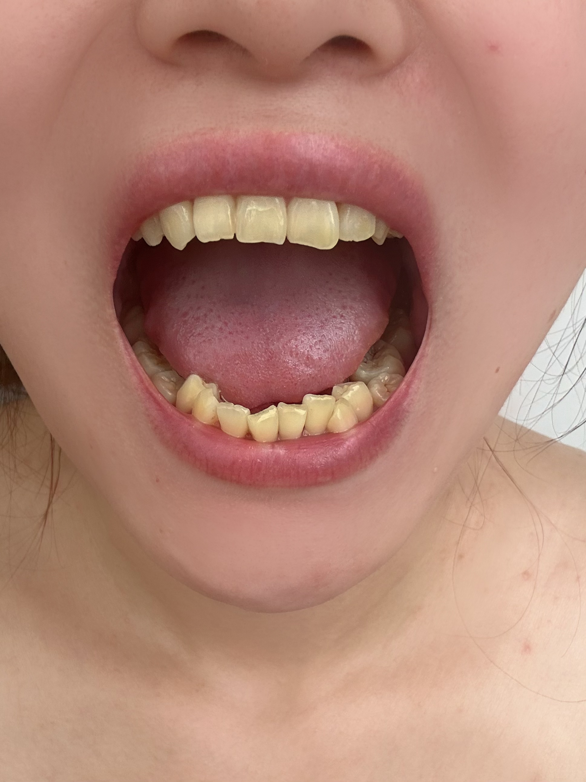 而且也不是特别注重清洁牙齿,不知不觉牙齿就变得好黄