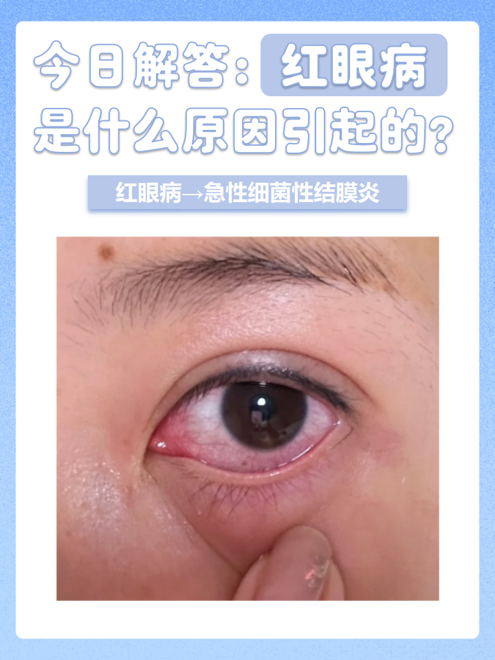 红眼病又叫急性细菌性结膜炎,这是一种常见的传染性眼病,多见于春秋