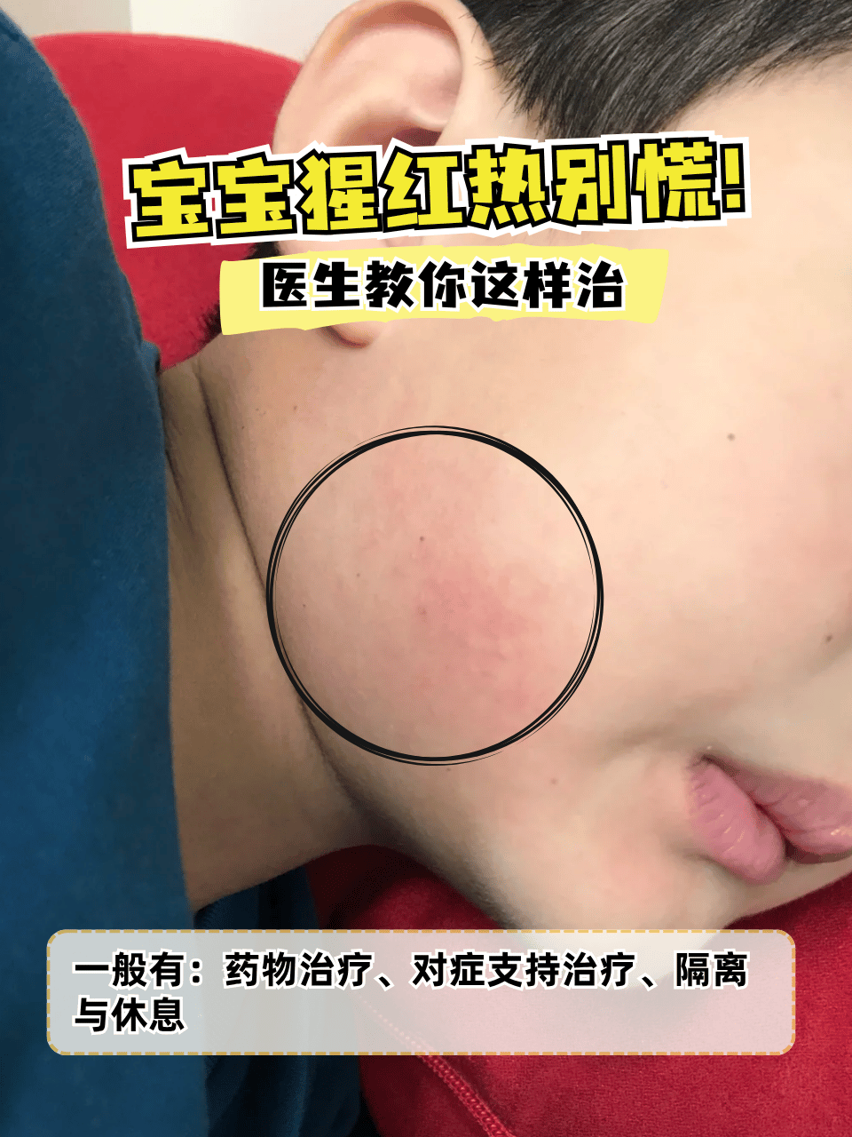 宝宝猩红热别慌!